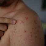 Dutch traveler brings first measles case to Panama since 1995