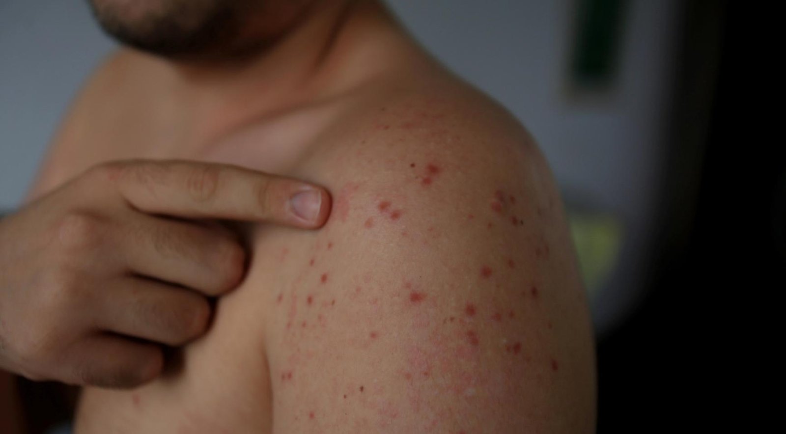 Dutch traveler brings first measles case to Panama since 1995