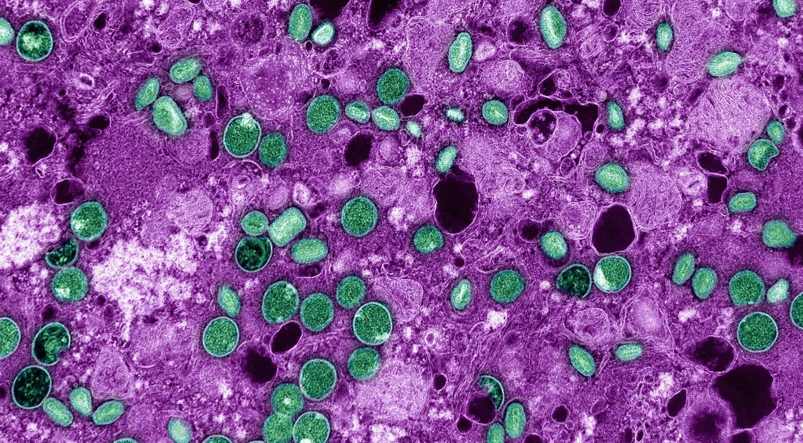 Senior Dutch virologist, colleague accused of smuggling inactive Mpox into United States
