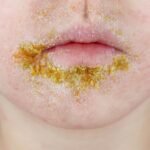 Impetigo cases among Dutch children surge higher and earlier than usual