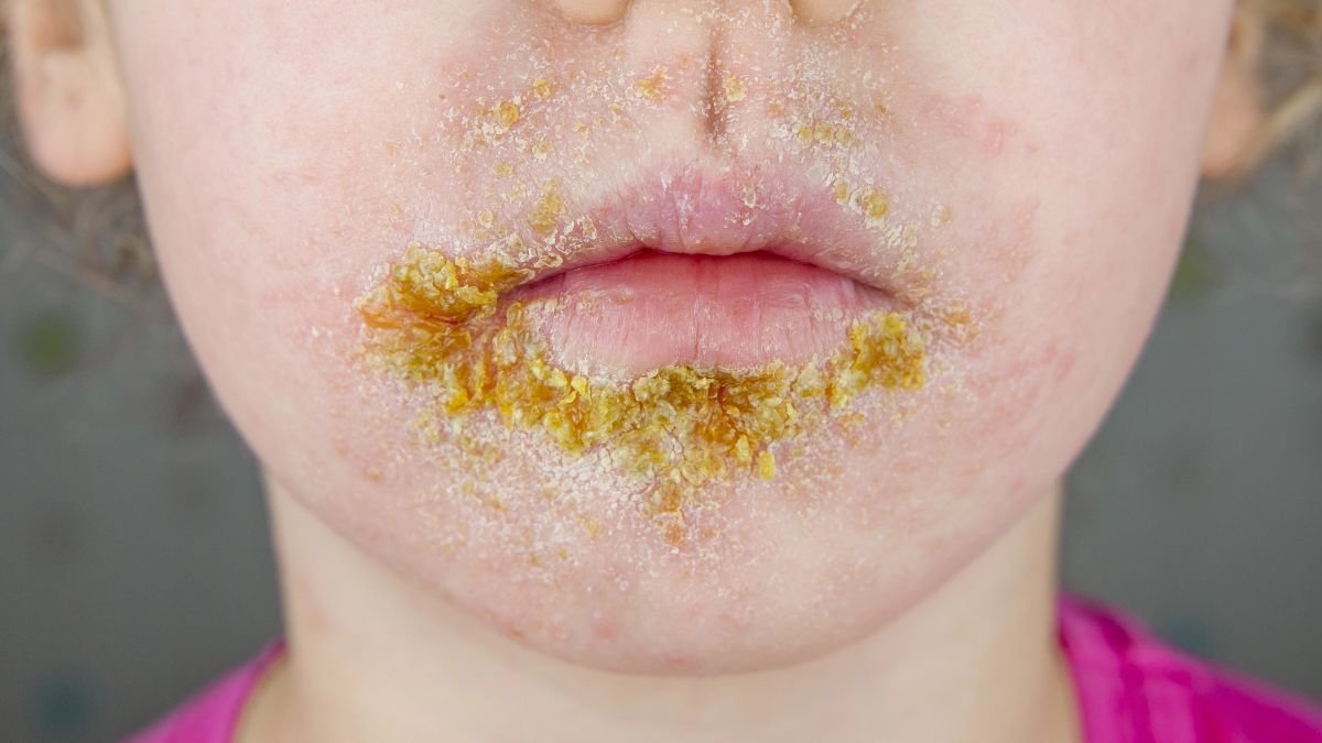 Highly contagious impetigo infection on the rise among children