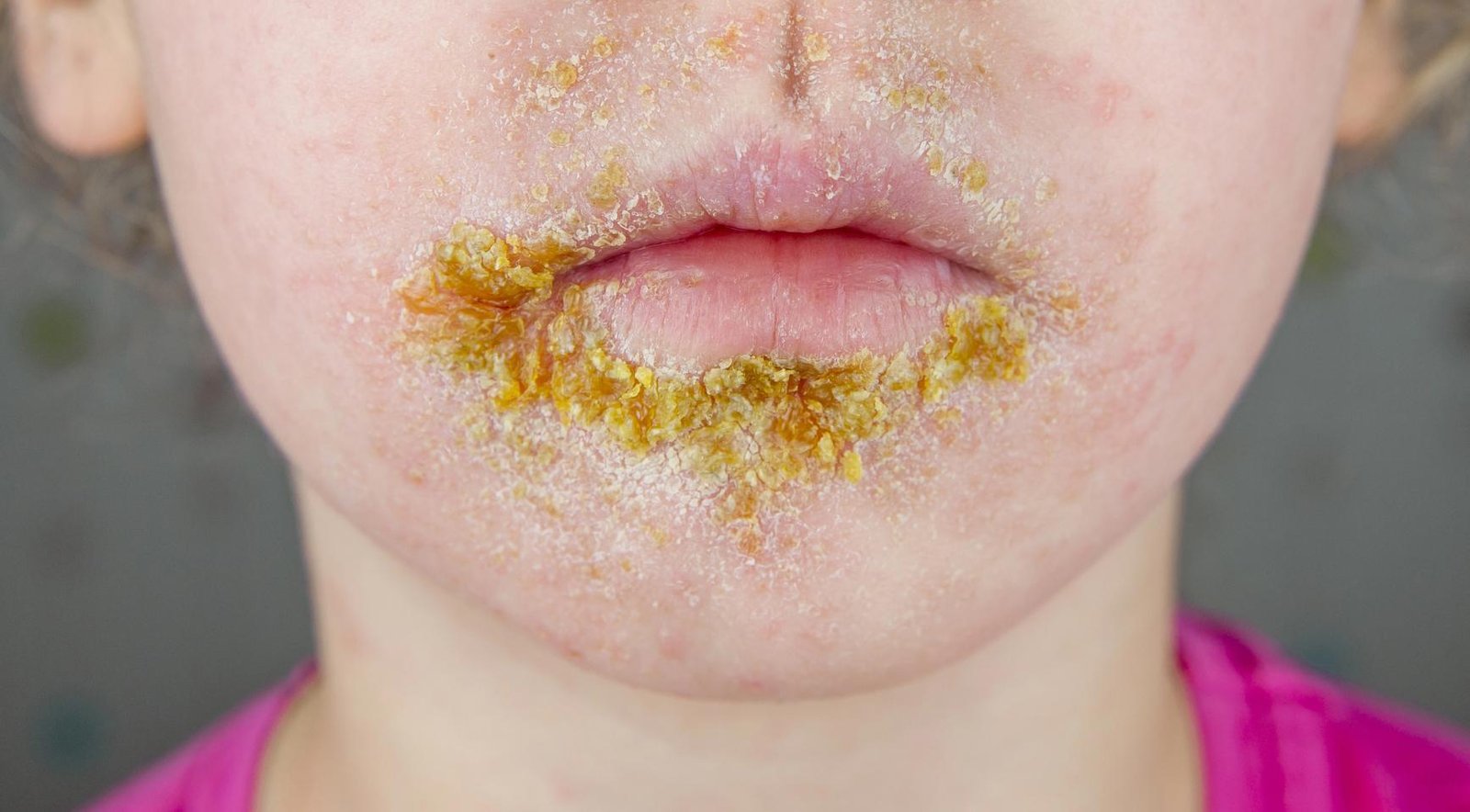 Impetigo infection cases among Dutch children surge higher and earlier than usual