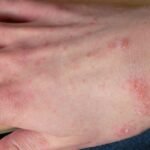 Dutch scabies cases stay elevated as treatment proves difficult