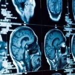 Amsterdam researchers find remedy for fatal child brain disease