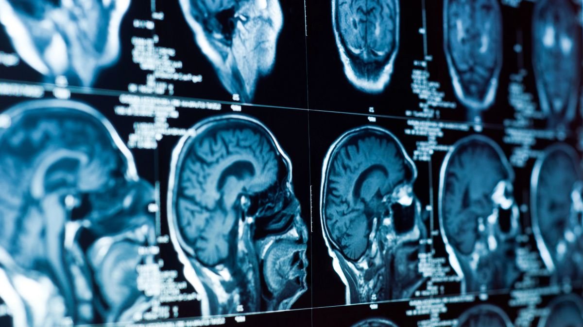 Amsterdam researchers find remedy for fatal child brain disease